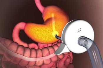 PEG (Perkütan endoskopik gastrostomi)