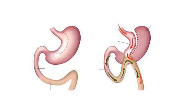 Roux-en-Y Gastrik Bypass (RYGB)