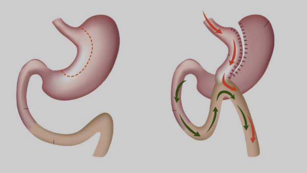 Mini Gastrik Bypass (MGB)